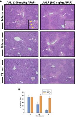 Interleukin-10 disrupts liver repair in acetaminophen-induced acute liver failure